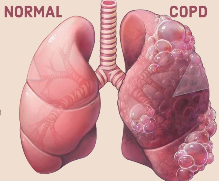 COPD- Top 10 Causes of Death in Humans around the World