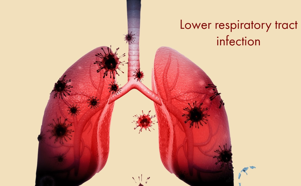 Lower respiratory tract infection- Top 10 Causes of Death in Humans around the World