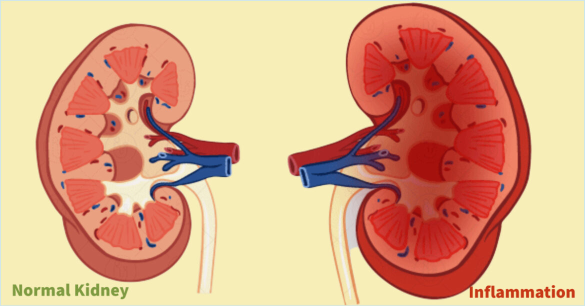 Nephritis- Top 10 Causes of Death in Humans around the World